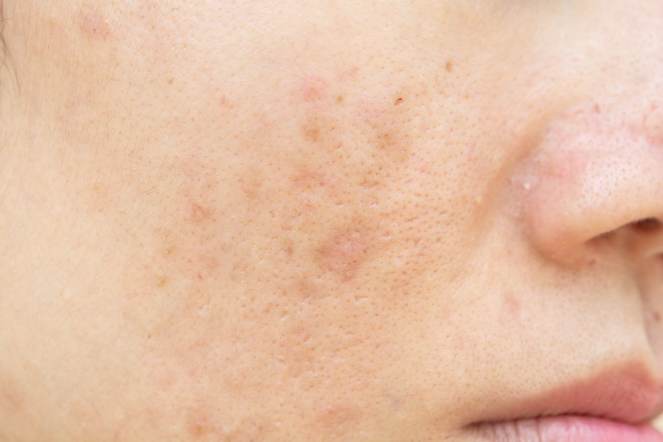 What Causes Liver Spots and How to Fade Them?