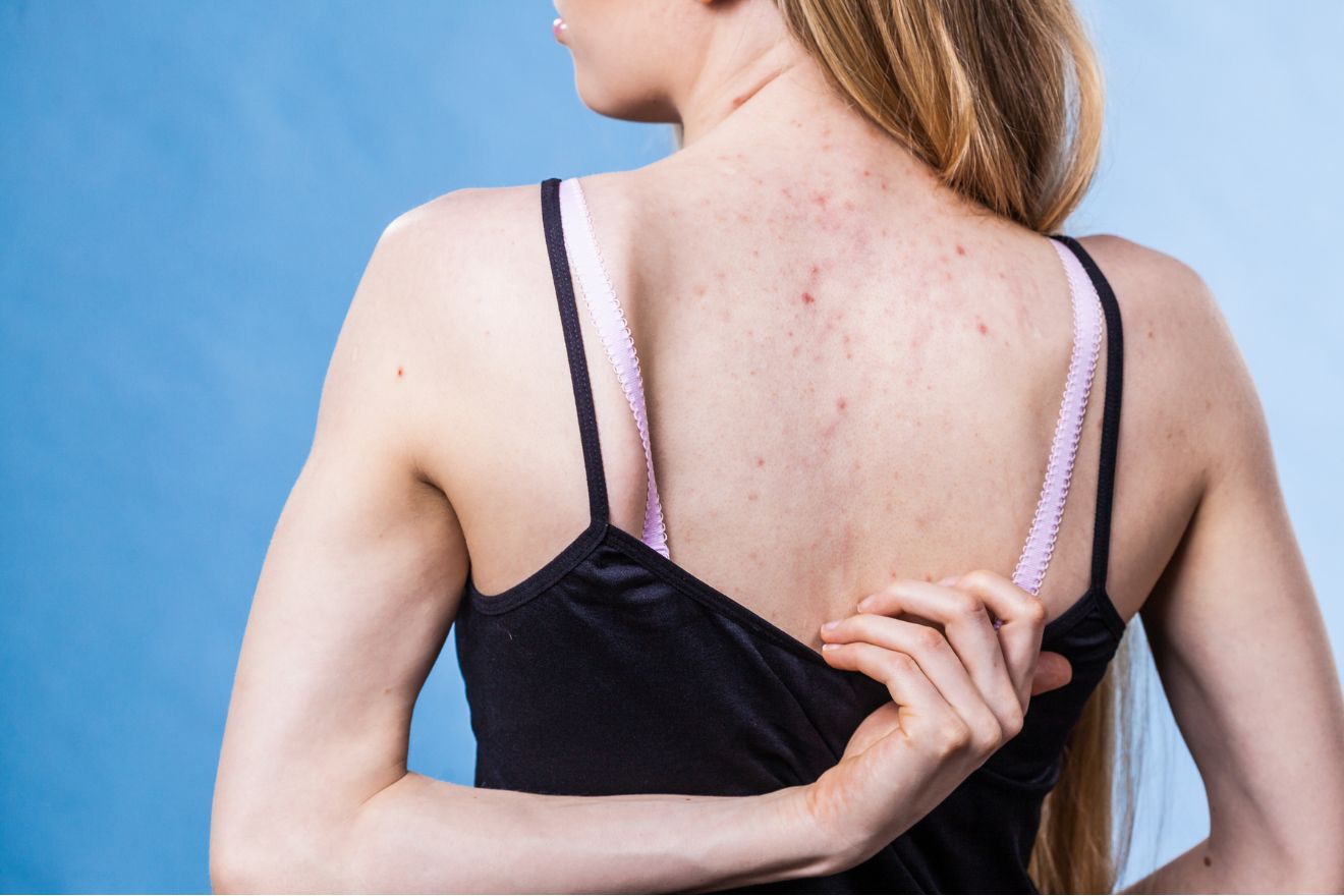 How to Get Rid of Back Acne (Without Losing Your Mind)