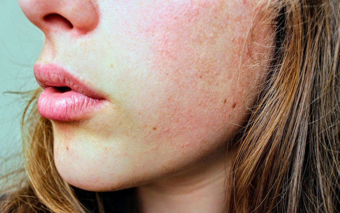 The Best Skincare Tips For Rosacea, Psoriasis, and Eczema