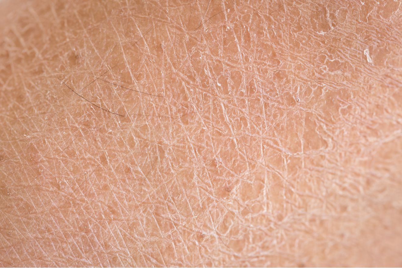 What Is Crepey Skin and What Causes It