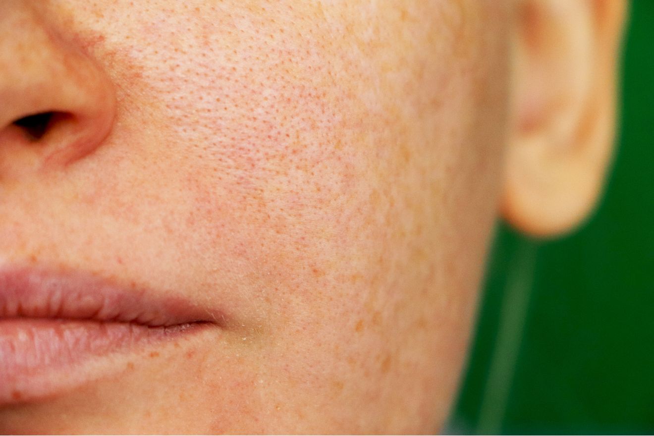 How to Reduce Sebaceous Filaments