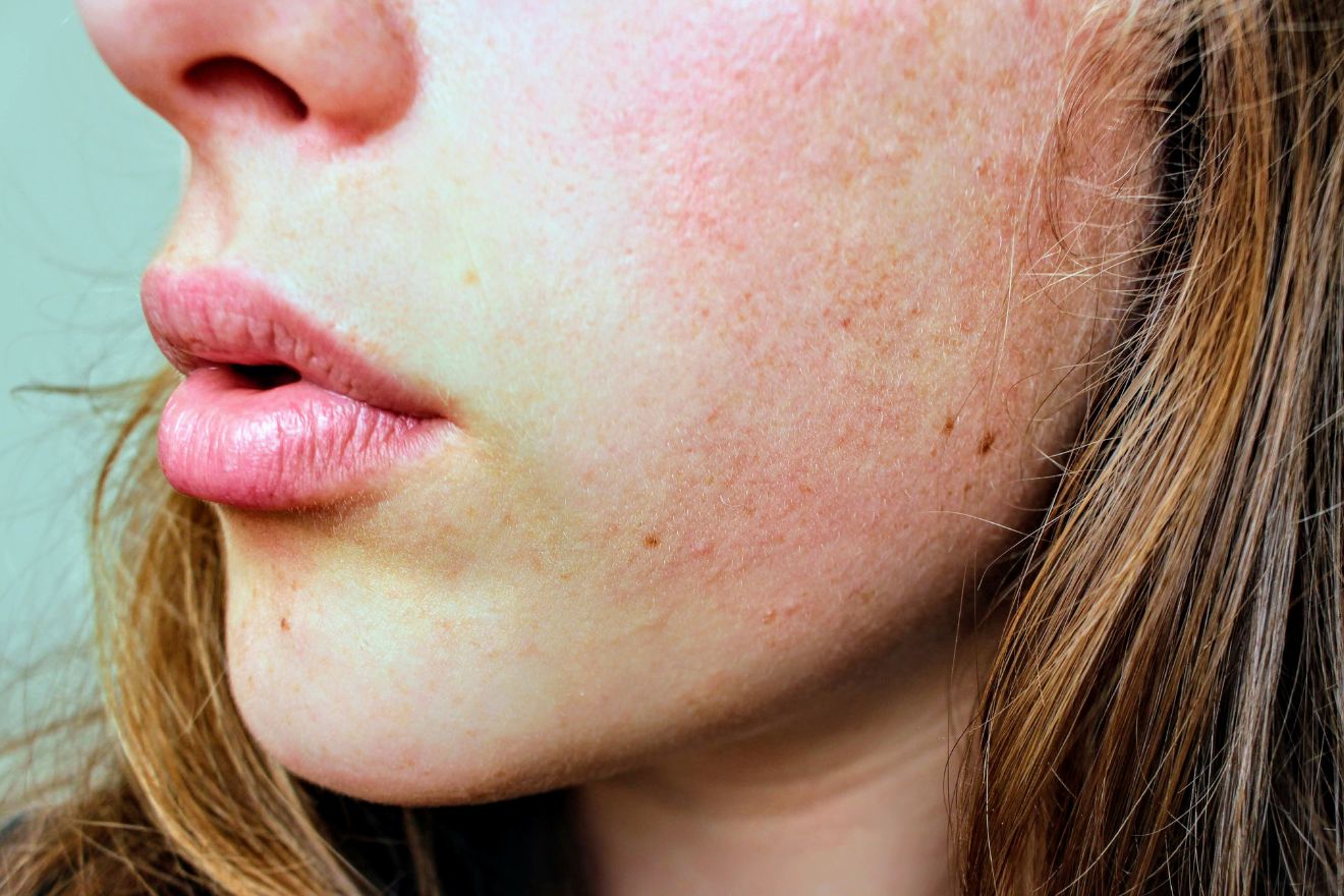 How to Reduce Skin Redness